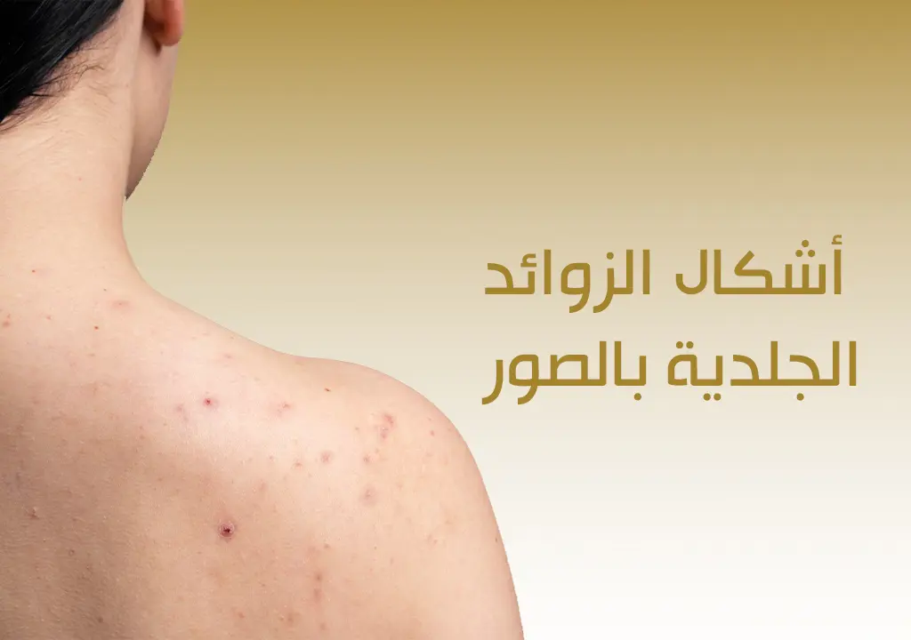 أشكال الزوائد الجلدية بالصور